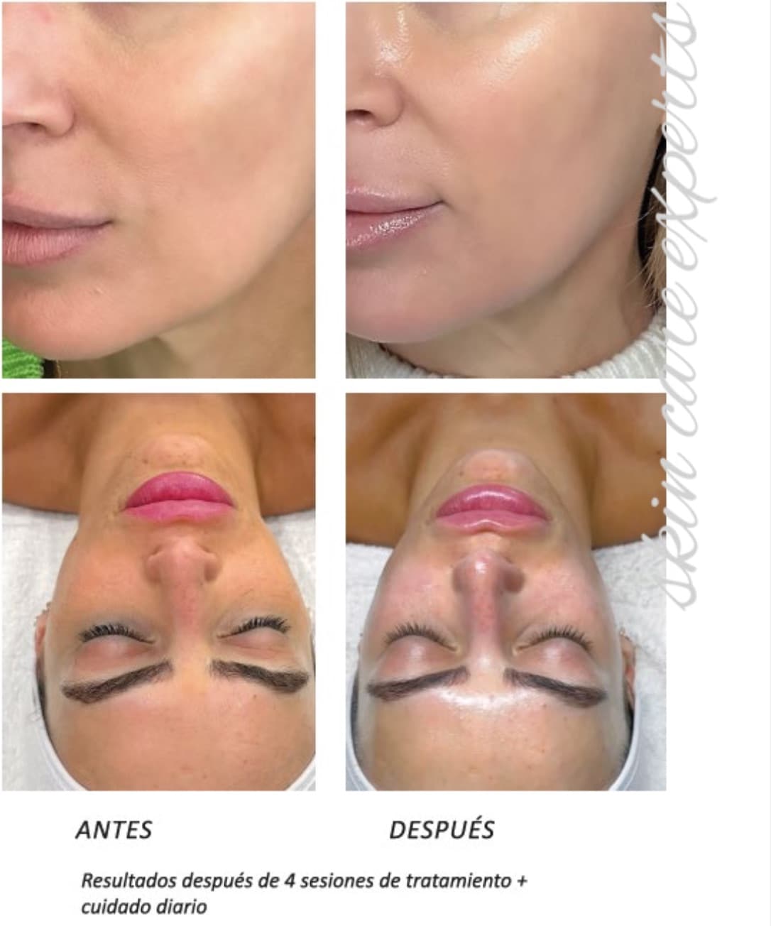 reset skin en belleza natural valladolid